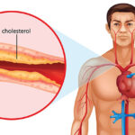 রক্তে cholesterol বেড়েছে? ঘরোয়া পদ্ধতিতে কি করে এটি নিয়ন্ত্রণ করবেন যেনে নিন