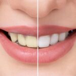 হলুদ ছোপ মুছে ধপধপে সাদা দাঁত চাই? যেনে নিন ঘরোয়া সমাধান