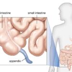 পেটের ব্যথাই ভুগছেন, appendicitis এর ব্যথা নয়তো, বিস্তারিত যেনে নিন