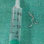 খাদ্যনালীতে ব্লাউজের হুক আটকে থাকা ১ মাসের শিশুর প্রাণ বাচাল sskm