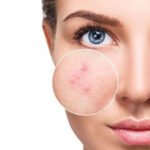 আপনি কি ব্রণর সমস্যায় ভুগছেন, জেনে নিন এর থেকে মুক্তি পাওর কিছু ঘরোয়া উপাই