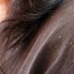 শীত কালে খুশকির সমস্যা? জেনে নিন এর থেকে মুক্তি পাওয়ার কিছু সহজ উপায়