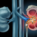 চিকিৎসা ছাড়াই কিডনির পাথর থেকে মুক্তি পেতে এই 8 ধরনের জুস পান করুন