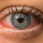 Red eyes: চোখ লাল হয়ে জল পড়ছে? জয়বাংলা নয়তো! জানুন কি করবেন