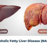 ফ্যাটি লিভারের প্রাথমিক লক্ষণগুলি কি কি, জেনে নিন বিশেষজ্ঞদের কাছে