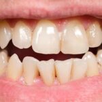 ২০ টাকার এই ২ টি জিনিস দাঁতের হলুদ ময়লা উপড়ে ফেলবে, ঝকঝকে হবে ৩২ পাটি দাঁত