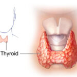 থাইরয়েড হলে কি করবেন এবং কি করবেন না? বিশেষজ্ঞদের কাছ থেকে গুরুত্বপূর্ণ বিষয় জানুন