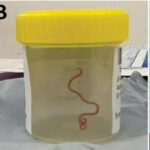 বিশ্বের প্রথম, অস্ট্রেলিয়ায় মহিলার মস্তিষ্কের ভিতরে ‘জীবিত এবং কুঁচকে যাওয়া’ পরজীবী কীট