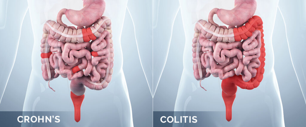 Ulcerative colitis : আলসারেটিভ কোলাইটিস কি, বিশেষজ্ঞরা কি বলছেন জেনে-নিন
