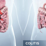 Ulcerative colitis : আলসারেটিভ কোলাইটিস কি, বিশেষজ্ঞরা কি বলছেন জেনে-নিন