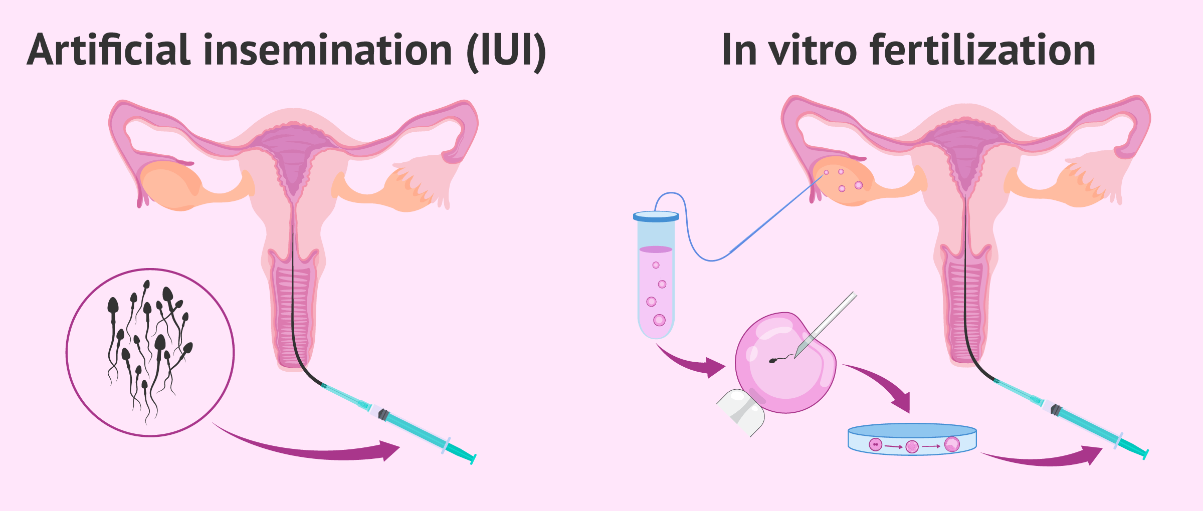 Difference between ivf and iui