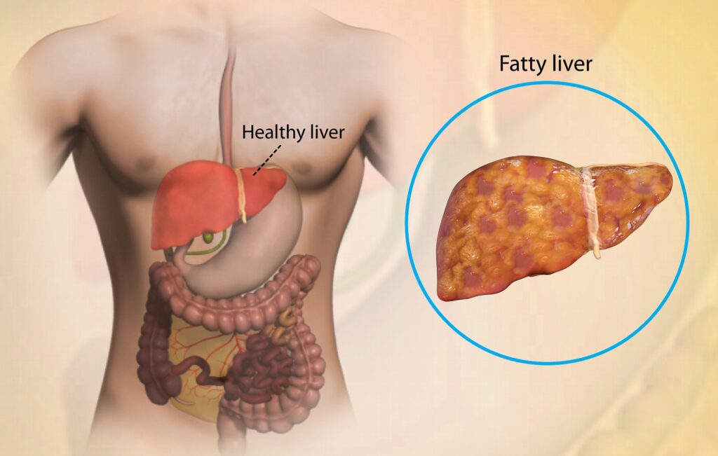 আপনার লিভার কি সঠিকভাবে কাজ করছে? মহিলাদের মধ্যে ফ্যাটি লিভার রোগের শীর্ষ ৫ সতর্কতামূলক লক্ষণ
