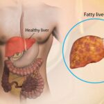 আপনার লিভার কি সঠিকভাবে কাজ করছে? মহিলাদের মধ্যে ফ্যাটি লিভার রোগের শীর্ষ ৫ সতর্কতামূলক লক্ষণ