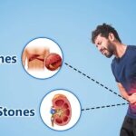কিডনি স্টোন বনাম পিত্তথলির পাথর, কীভাবে কেউ এর মধ্যে পার্থক্য করতে পারে জানুন বিশেষজ্ঞদের কাছে