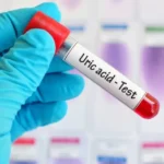 প্রাকৃতিক উপায়ে কিভাবে ইউরিক অ্যাসিডের মাত্রা কমানো যায়, রইলো কিছু টিপস