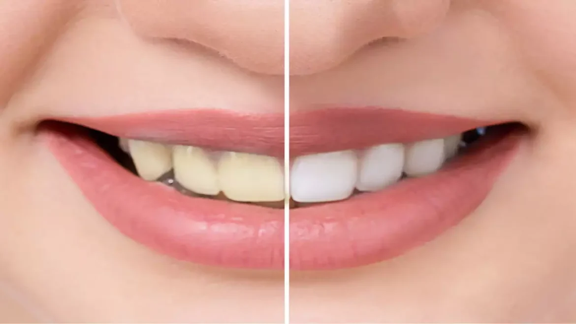 Whiten your yellow teeth with 5 natural herbs