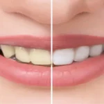 ৫ টি প্রাকৃতিক ভেষজের মাধ্যমে আপনার হলুদ দাঁত সাদা করুন এখনি