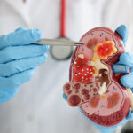 কিডনিতে পাথর জমে আছে? হোমিওপ্যাথি ওষুধ নয়, ঘরেই তৈরি করুন এই স্বাস্থ্যকর পানীয়