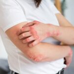 বর্ষায় ফাঙ্গাল ইনফেকশনের আক্রমণ, আতঙ্কিত না হয়ে ভরসা করুন এই ঘরোয়া প্রতিকার!