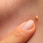 আঁচিল নিয়ে আর টেনশন নয়, মাত্র দুই সপ্তাহে ঘরোয়া প্রতিকার