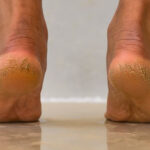 পায়ের গোড়ালি ফেটে বেরোচ্ছে রক্ত? সমাধান লুকিয়ে আছে আপনার রান্নাঘরে!