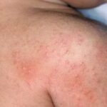 গরমে ঘামাচি ভীষণ কষ্টকর, জেনে নিন কীভাবে ঘরে বসে ঘামাচি নিরাময় করবেন