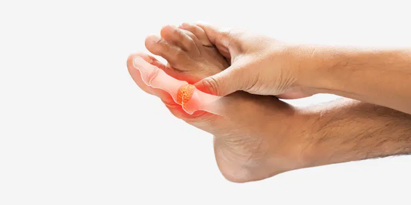 Control dangerous URIC ACID using these natural methods