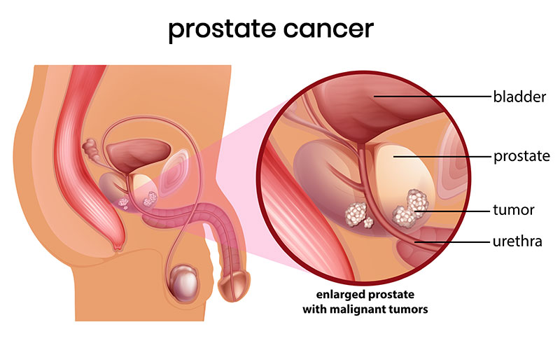 What is prostate cancer? What are the symptoms and treatment methods?