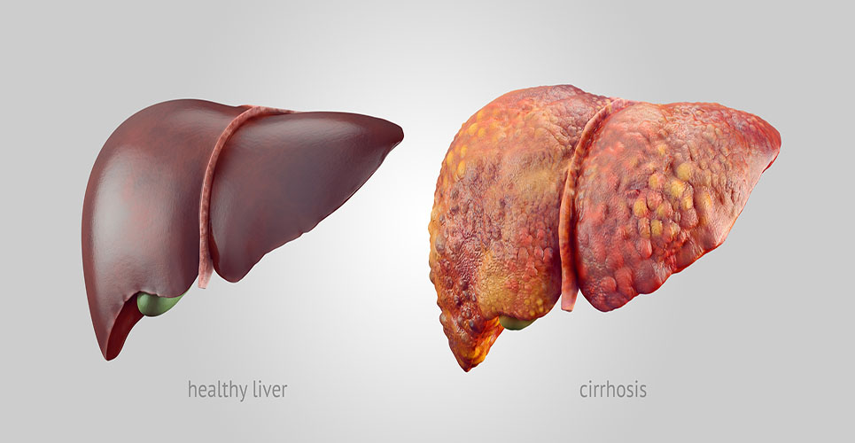 Apart from drinking, these 6 common habits are also damaging your liver
