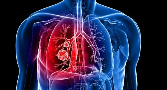 Know the 6 early signs of lung cancer that we easily ignore