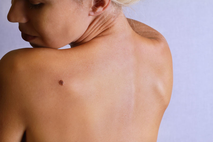 Let's find out what is the scientific explanation behind moles appearing on the body.