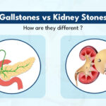 কিডনিতে পাথর এবং পিত্তথলির পাথরের লক্ষণ কি কি? চিকিৎসা পদ্ধতি কি? আসুন জেনে নেওয়া যাক