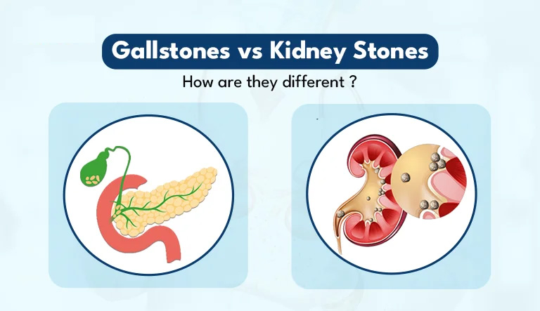 What are the symptoms of kidney stones and gallstones Let's find out