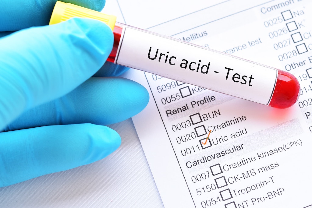 Avoid these 6 foods to get rid of uric acid problems