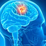 ব্রেন টিউমার: শরীরে এই লক্ষণগুলি দেখলে সতর্ক থাকুন! এটি ব্রেন টিউমার হতে পারে