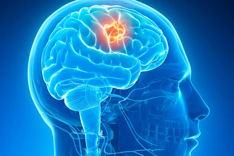 Brain Tumor: Be careful if you see these symptoms in your body! It could be a brain tumor