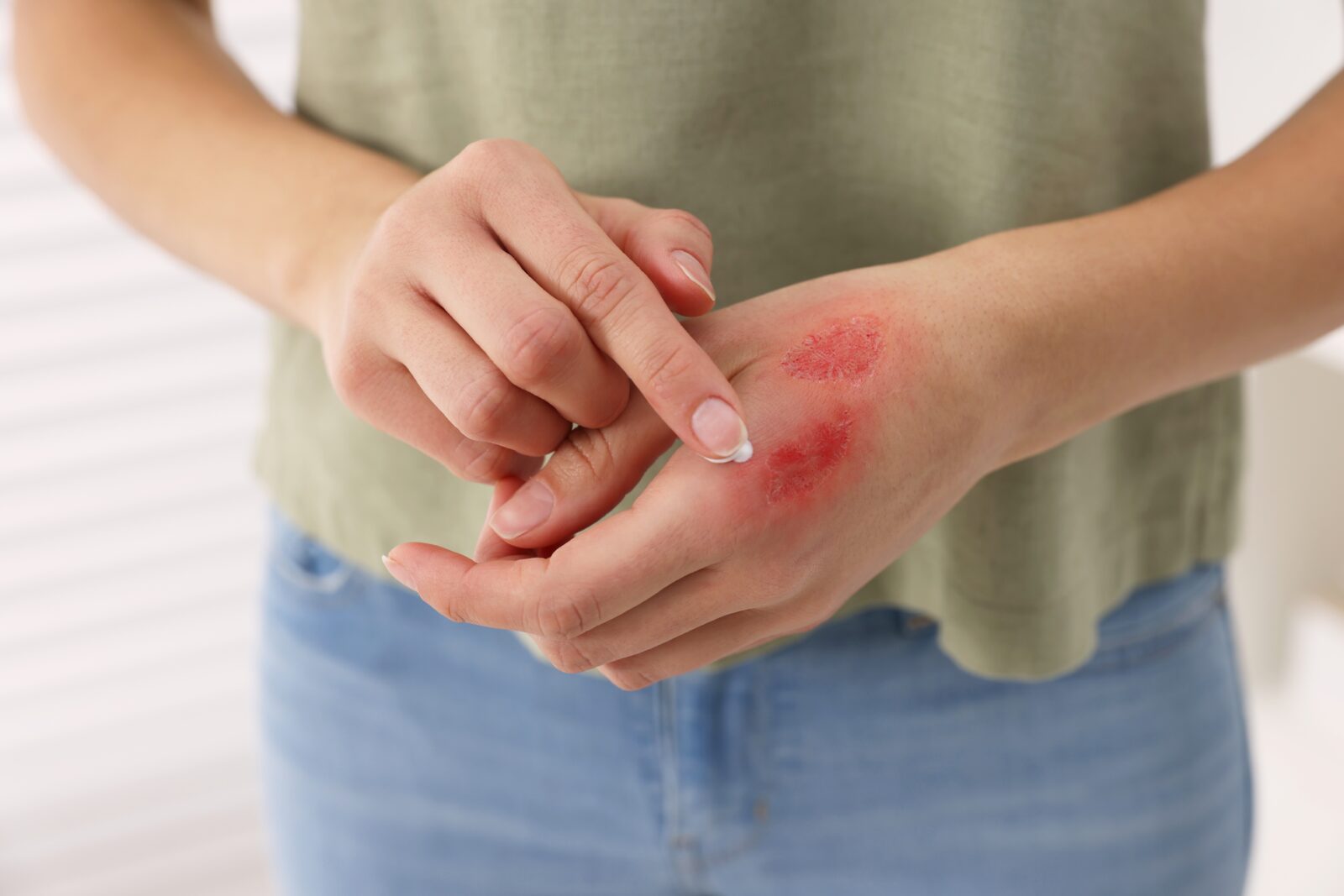 Got a burn? Kitchen magic will give you instant relief