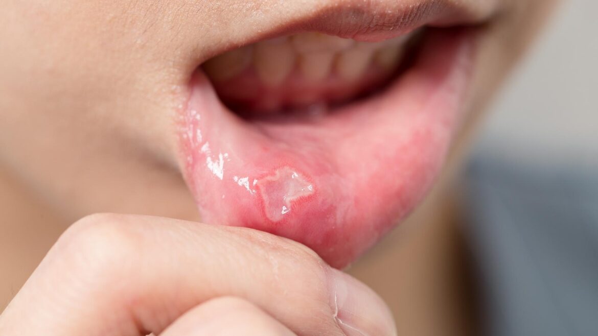 If you have frequent mouth ulcers, swelling, and pain, then definitely try this home remedy.