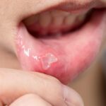 যদি আপনার ঘন ঘন মুখের আলসার, ফোলা ভাব এবং ব্যথার সমস্যা থাকে, তাহলে অবশ্যই এই ঘরোয়া প্রতিকারটি ব্যবহার করে দেখুন।