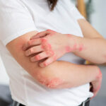 ত্বক চুলকাচ্ছে? ছত্রাকের সংক্রমণ নয়তো? বিশেষজ্ঞরা কি বলছেন জানুন