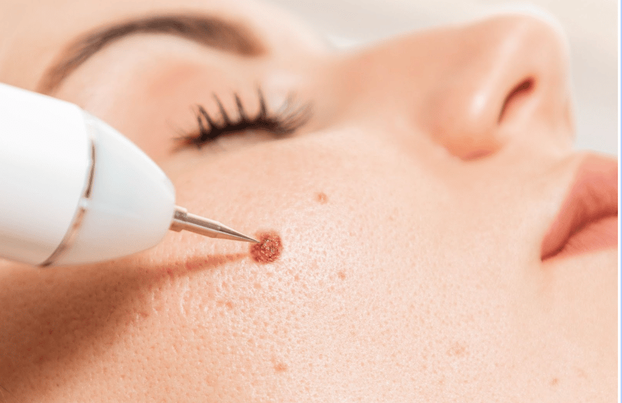 Moles and warts on the face are the enemy of beauty, this home remedy will provide miraculous benefits.