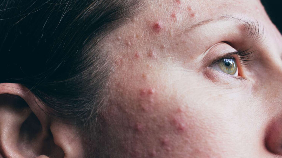 Tips for removing acne: Follow these tips, acne will go away!