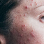 ব্রণ দূর করার টিপস: এই টিপসগুলো মেনে চলুন, ব্রণ দূর হয়ে যাবে!