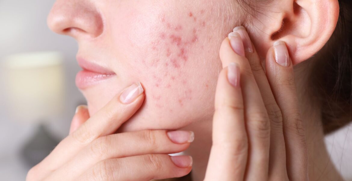 Why do we get acne? Experts reveal 4 health conditions, from digestive problems to hormonal problems