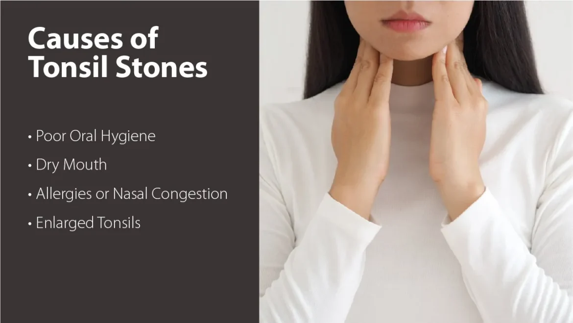 What are tonsil stones? How to prevent them, what to do and what to avoid you must know