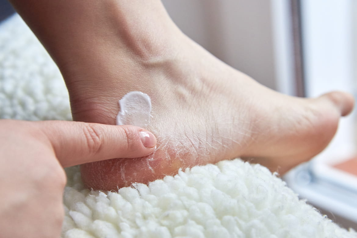 Get rid of cracked heels with home remedies, get rid of terrible pain, know