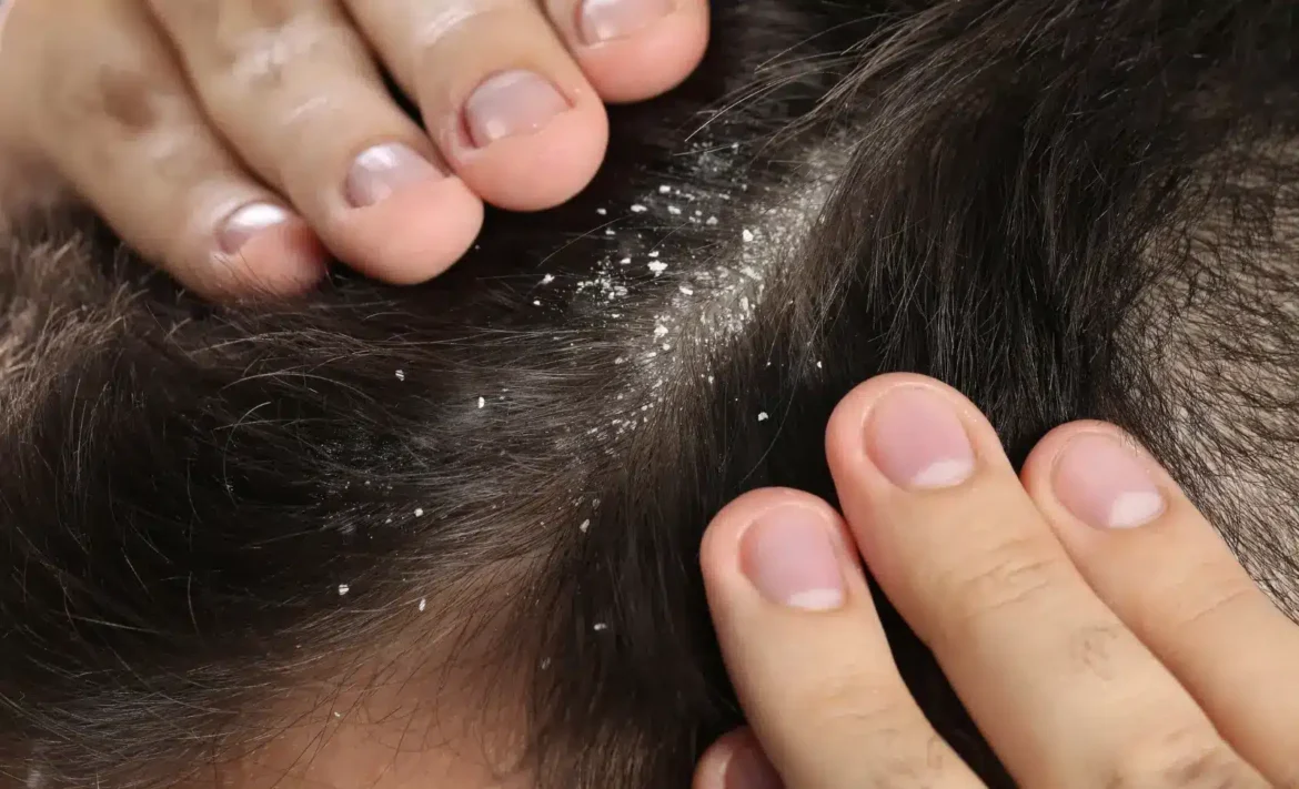 Dandruff can be a cause of concern for your scalp, here's how to get rid of it
