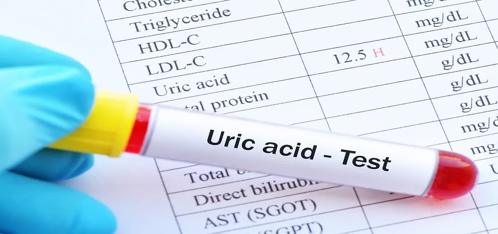Are your uric acid levels frequently rising? Find out from your doctor how to control it