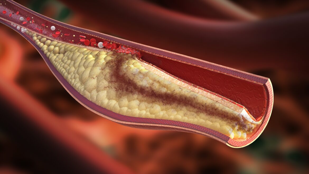 Five leaves that help reduce cholesterol and reduce the risk of heart disease