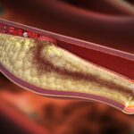 কোলেস্টেরল কমিয়ে হৃদরোগের ঝুঁকি কমাতে সাহায্য করে এমন পাঁচটি পাতা